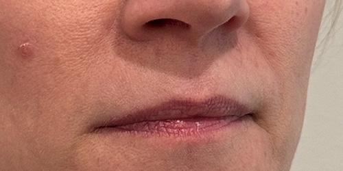Lip Filler result at Jewell Aesthetics in Dallas, TX