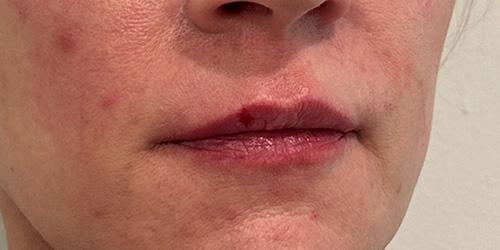 Lip Filler result at Jewell Aesthetics in Dallas, TX