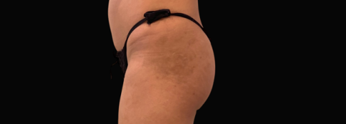 Brazilian Butt Lift after at Jewell Aesthetics in Dallas, TX