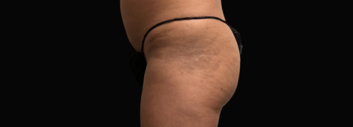 Brazilian Butt Lift before at Jewell Aesthetics in Dallas, TX