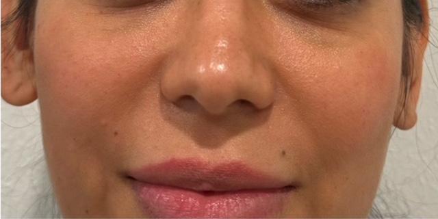 Jewell Aesthetics microneedling after — Dallas, TX