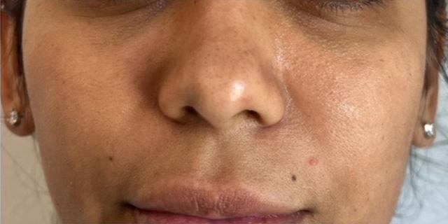 Chemical Peel before at Jewell Aesthetics in Dallas, TX