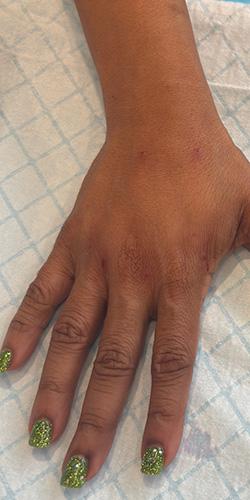 Jewell Aesthetics after — Dallas, TX
