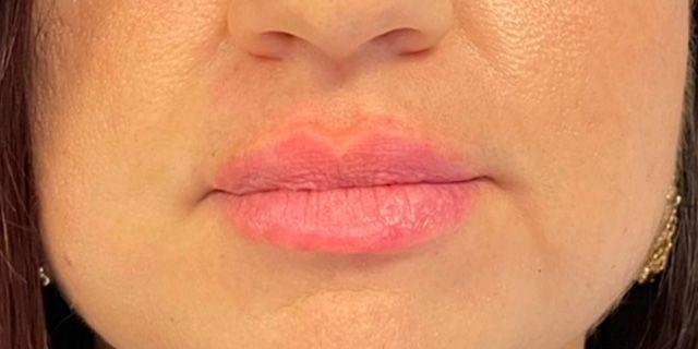 Jewell Aesthetics lip filler after — Dallas, TX