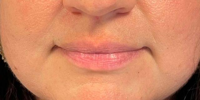 Lip Filler before at Jewell Aesthetics in Dallas, TX