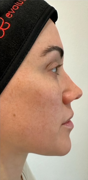 Breast Reduction before at Jewell Aesthetics in Dallas, TX