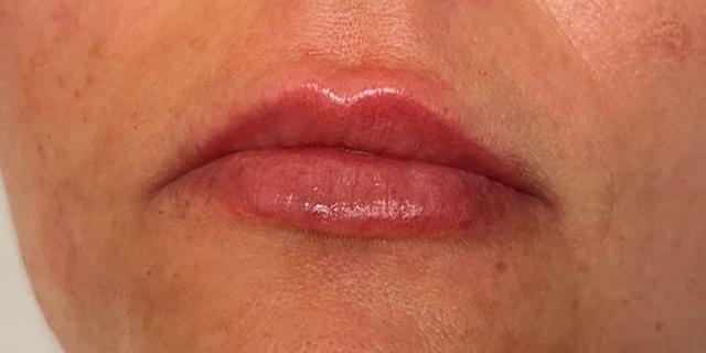 Jewell Aesthetics breast augmentation after — Dallas, TX