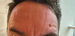 Botox after at Jewell Aesthetics in Dallas, TX