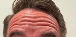 Botox before at Jewell Aesthetics in Dallas, TX