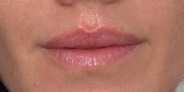 Jewell Aesthetics lip filler after — Dallas, TX