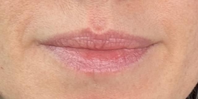 Lip Filler before at Jewell Aesthetics in Dallas, TX