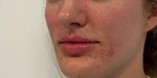 Lip Filler after at Jewell Aesthetics in Dallas, TX
