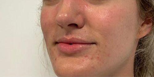 Lip Filler before at Jewell Aesthetics in Dallas, TX