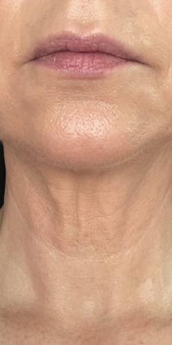 Jewell Aesthetics after — Dallas, TX
