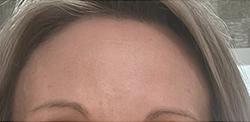 Botox after at Jewell Aesthetics in Dallas, TX