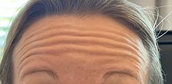 Botox before at Jewell Aesthetics in Dallas, TX