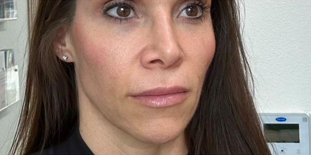 Dermal Fillers after at Jewell Aesthetics in Dallas, TX