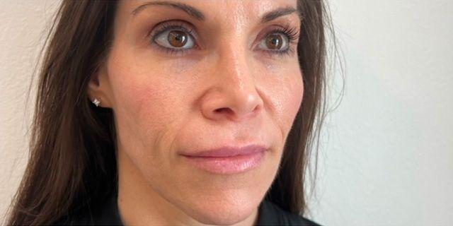 Dermal Fillers before at Jewell Aesthetics in Dallas, TX