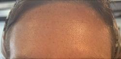 Botox after at Jewell Aesthetics in Dallas, TX