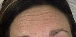 Botox before at Jewell Aesthetics in Dallas, TX