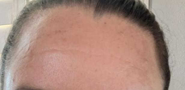Botox after at Jewell Aesthetics in Dallas, TX