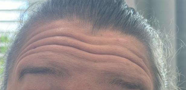 Botox before at Jewell Aesthetics in Dallas, TX