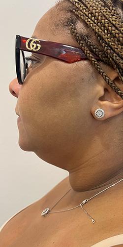 Breast Reduction before at Jewell Aesthetics in Dallas, TX