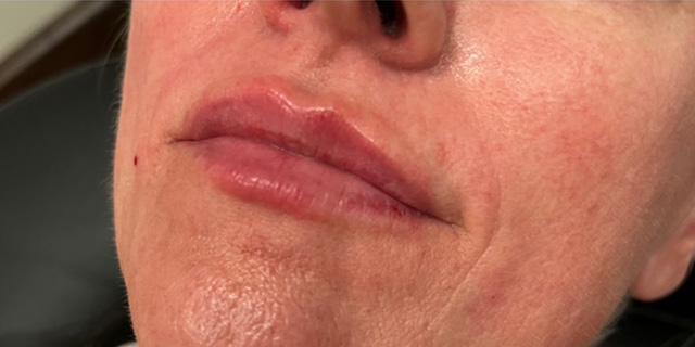 Jewell Aesthetics breast augmentation after — Dallas, TX