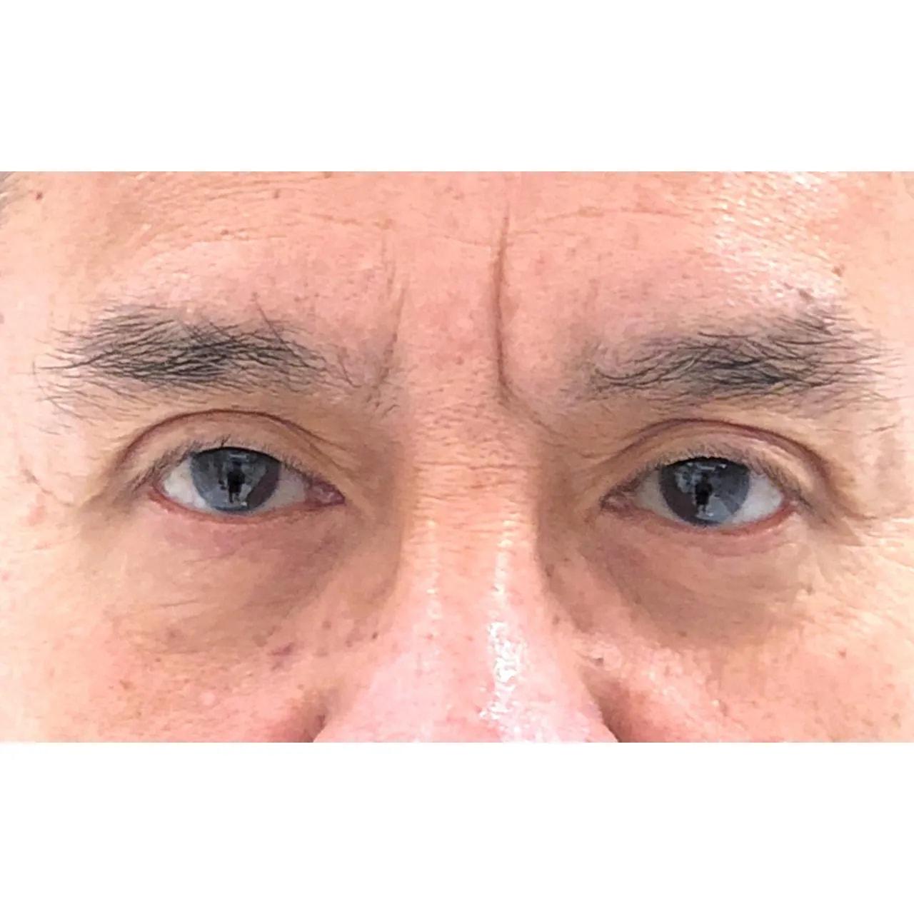 Hooman Khorasani, MD eyelid lift after — New York, NY