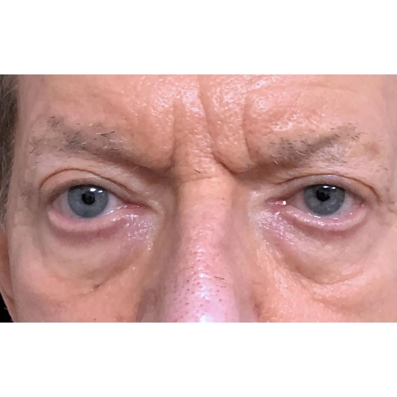 Hooman Khorasani, MD eyelid lift after — New York, NY