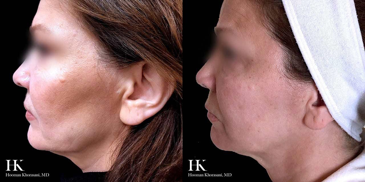 Hooman Khorasani, MD thread lift after — New York, NY