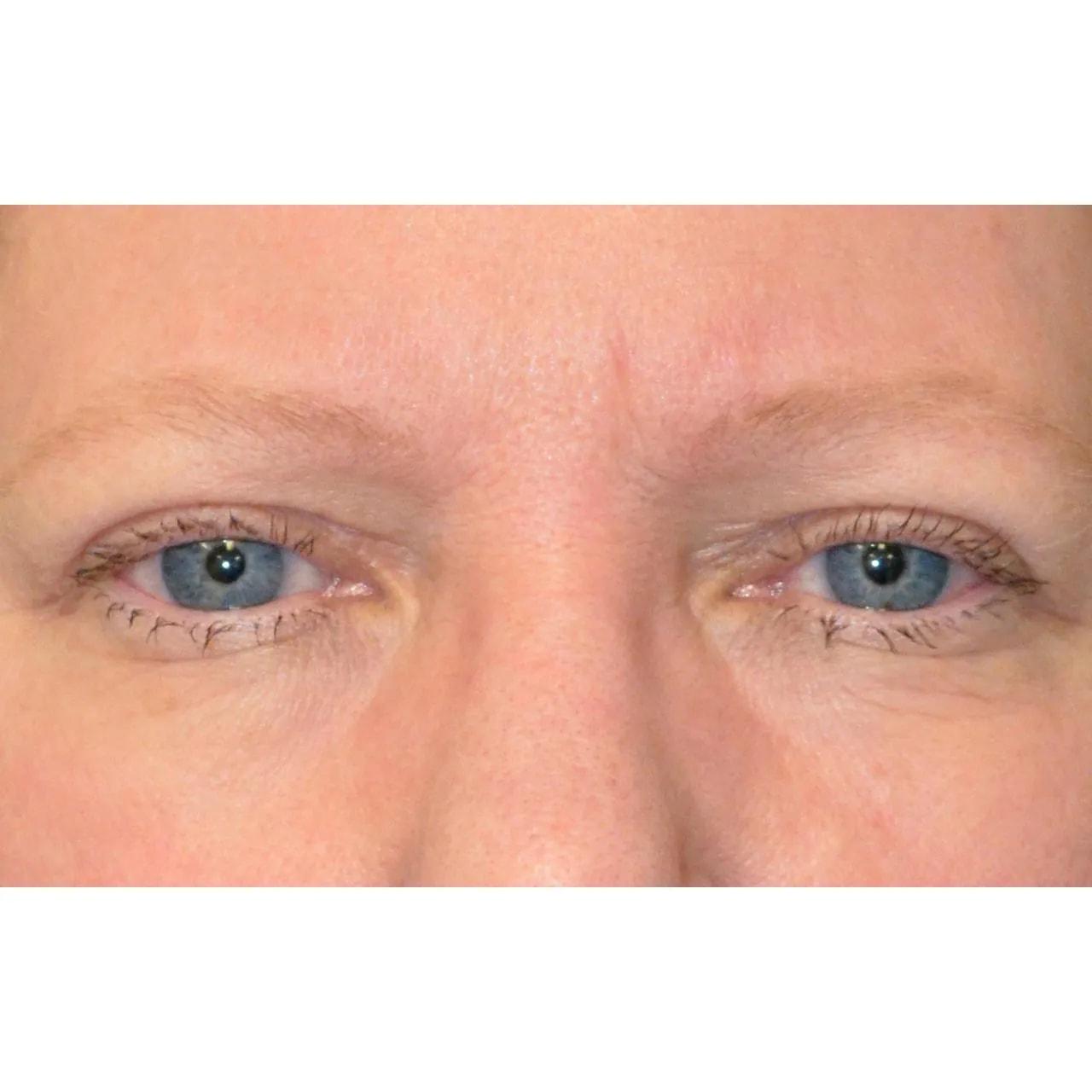 Hooman Khorasani, MD eyelid lift after — New York, NY