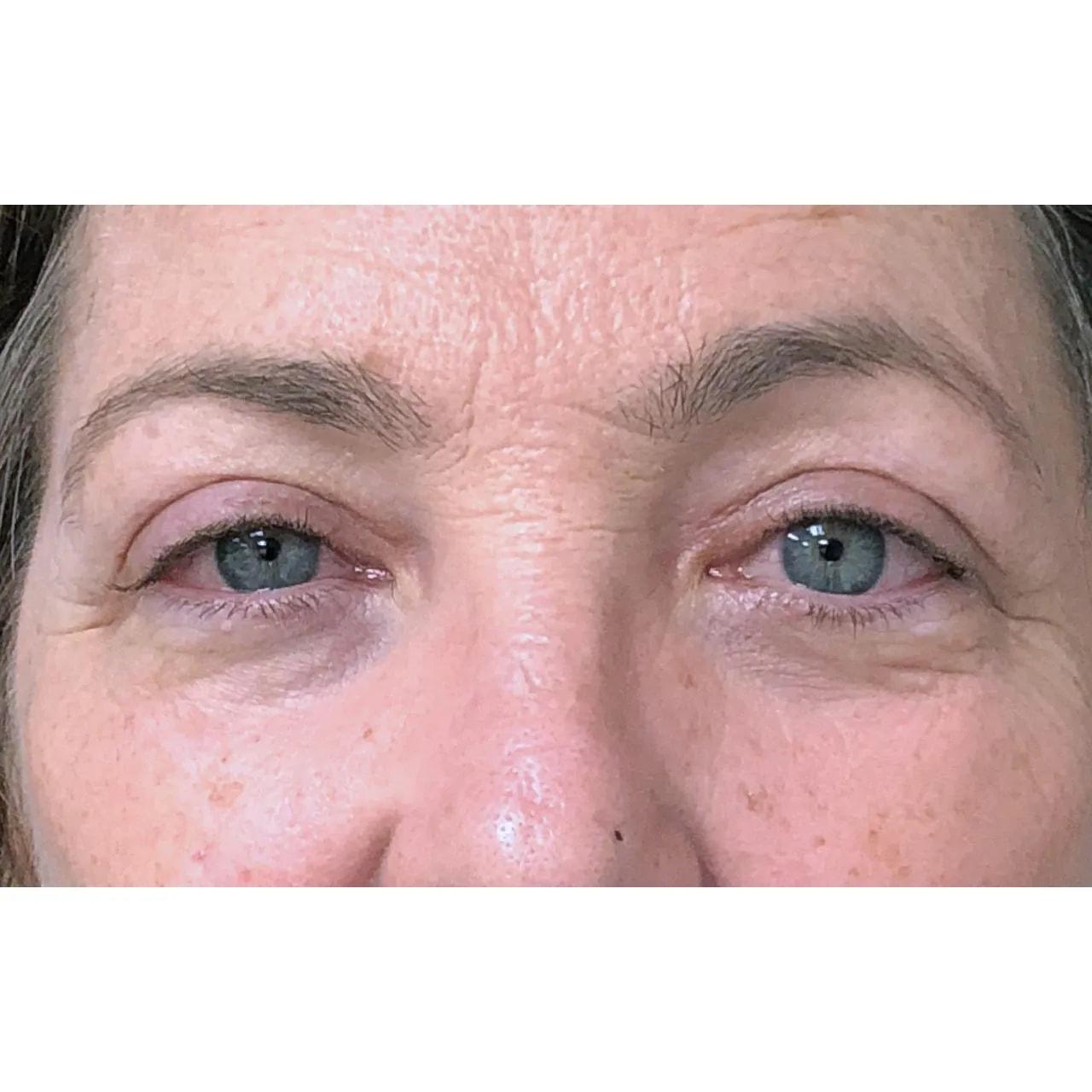 Hooman Khorasani, MD eyelid lift after — New York, NY