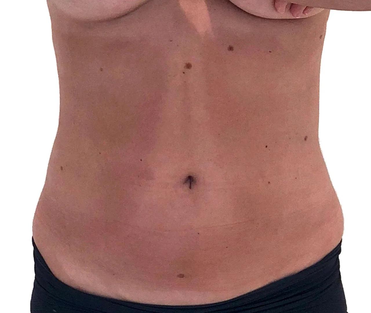 Hooman Khorasani, MD liposuction after — New York, NY