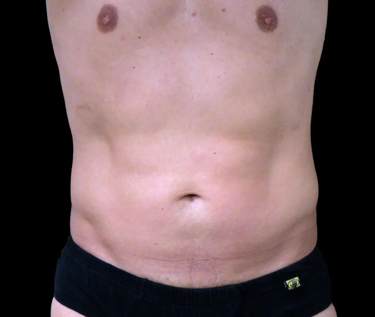 Hooman Khorasani, MD liposuction after — New York, NY