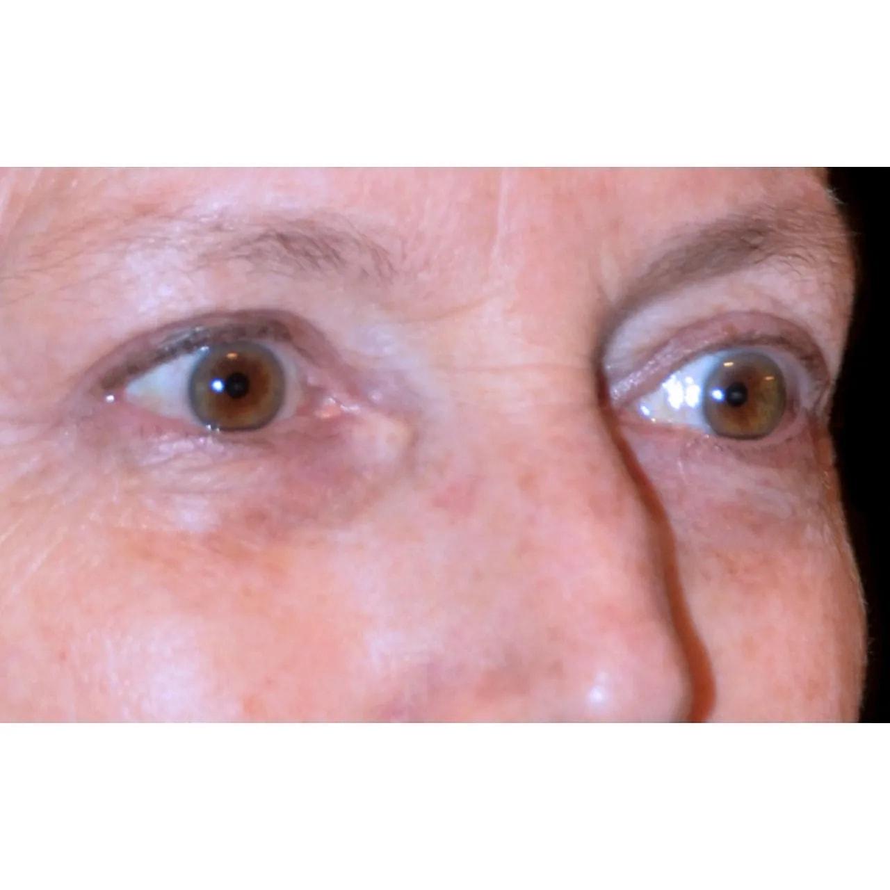 Hooman Khorasani, MD eyelid lift after — New York, NY