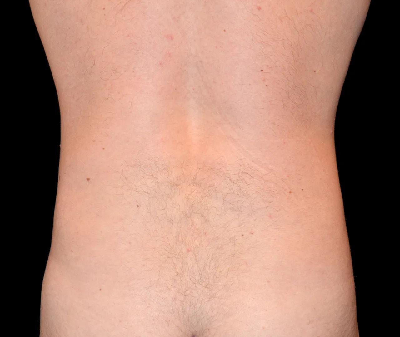 Hooman Khorasani, MD liposuction after — New York, NY