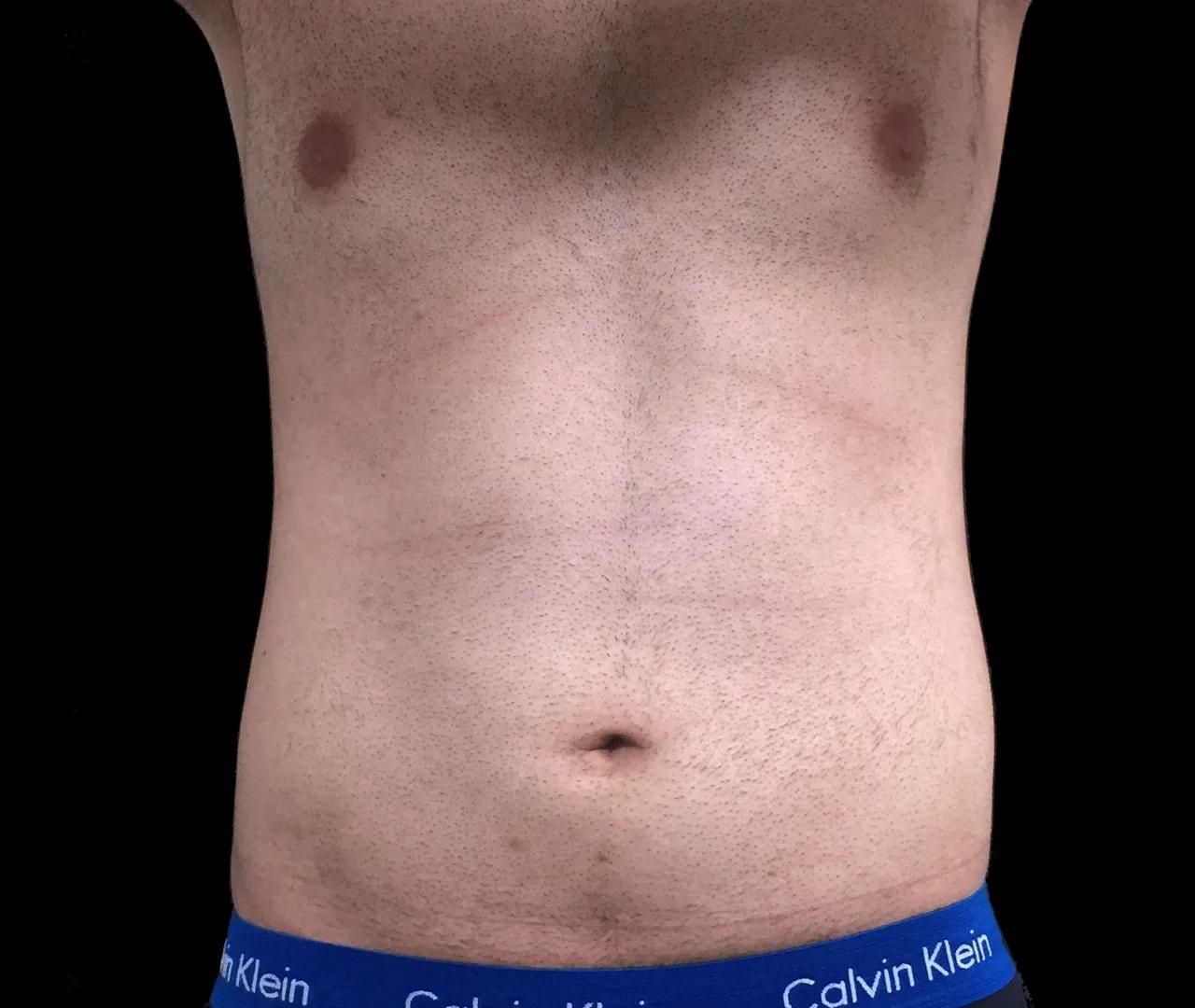 Hooman Khorasani, MD liposuction after — New York, NY