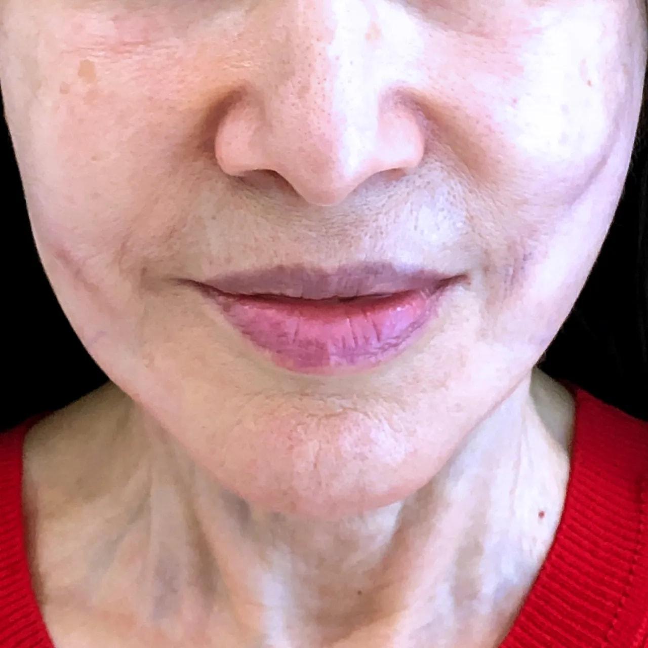 Hooman Khorasani, MD thread lift after — New York, NY