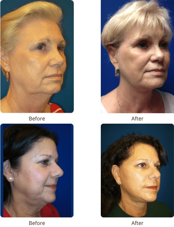 Plastic Surgery Specialists of Boca Raton neck lift result — Boca Raton, FL