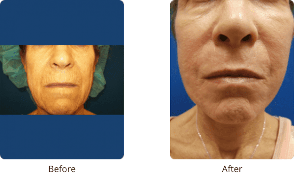 Plastic Surgery Specialists of Boca Raton neck lift result — Boca Raton, FL