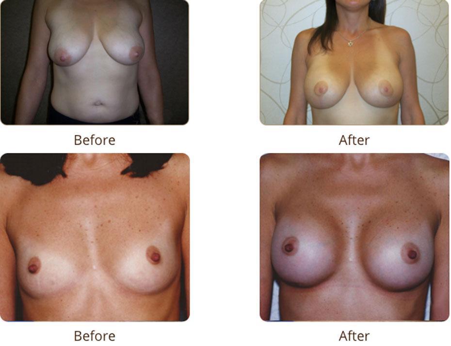Plastic Surgery Specialists of Boca Raton breast augmentation result — Boca Raton, FL