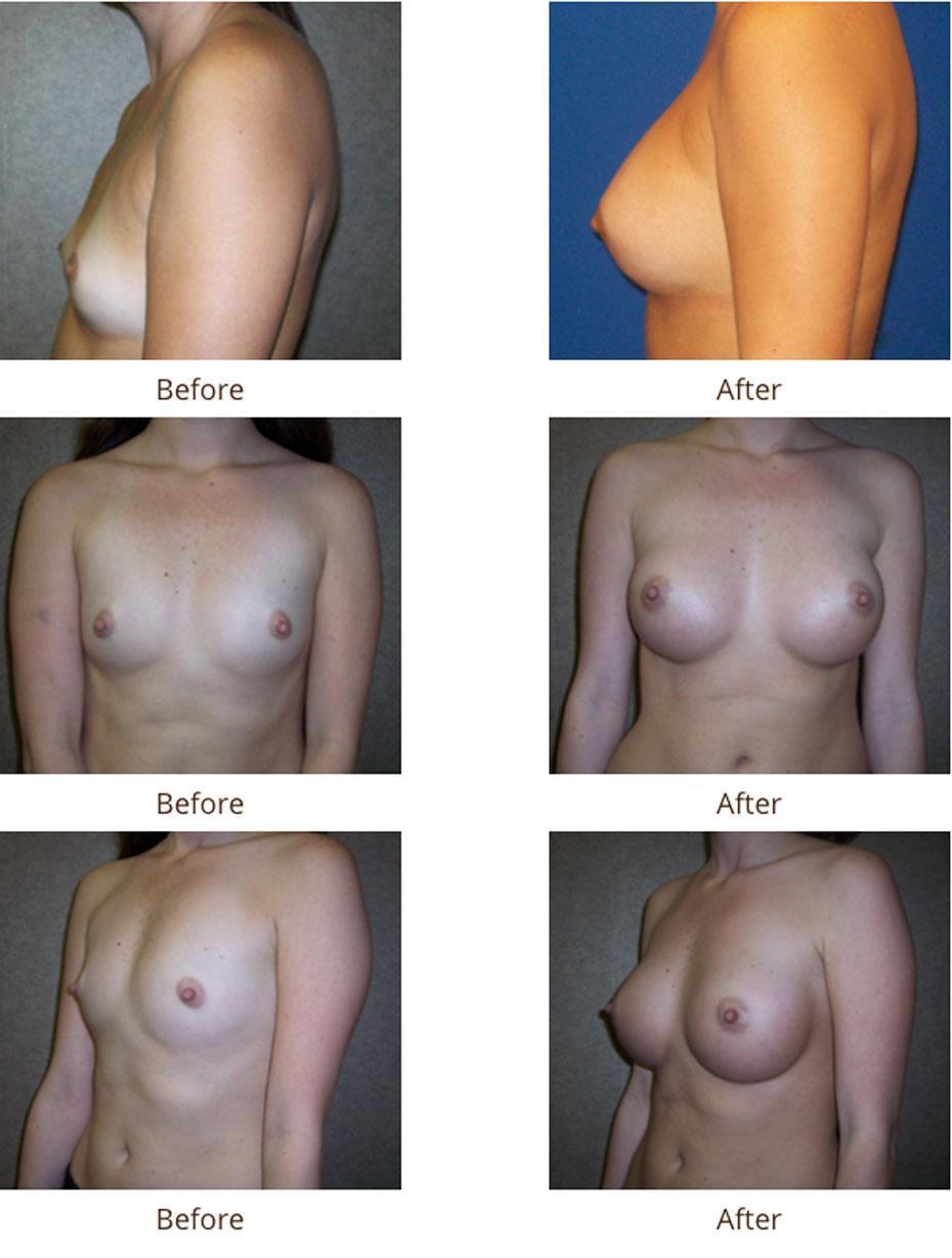 Plastic Surgery Specialists of Boca Raton breast augmentation result — Boca Raton, FL
