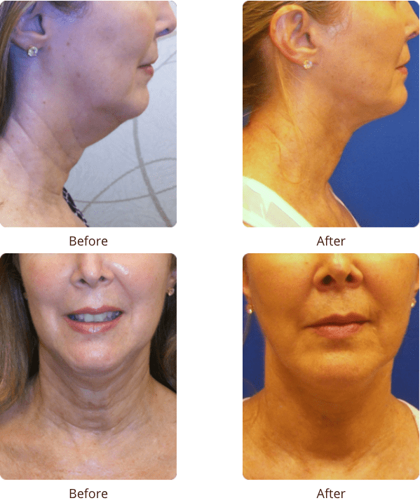 Plastic Surgery Specialists of Boca Raton neck lift result — Boca Raton, FL
