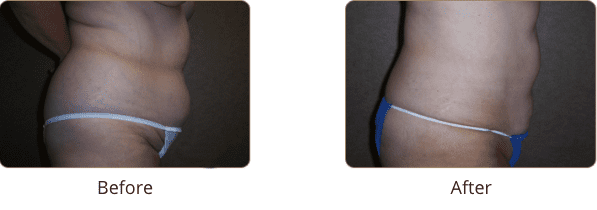 Plastic Surgery Specialists of Boca Raton liposuction result — Boca Raton, FL