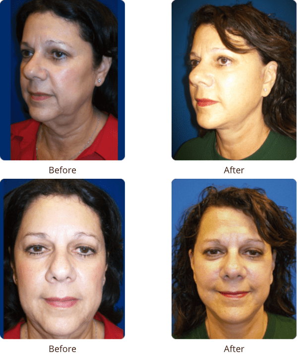 Plastic Surgery Specialists of Boca Raton neck lift result — Boca Raton, FL