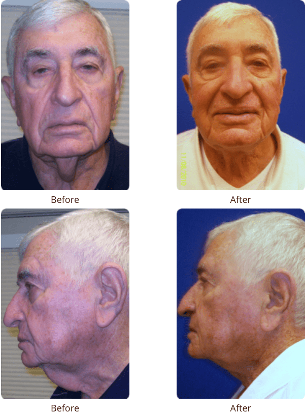 Plastic Surgery Specialists of Boca Raton neck lift result — Boca Raton, FL
