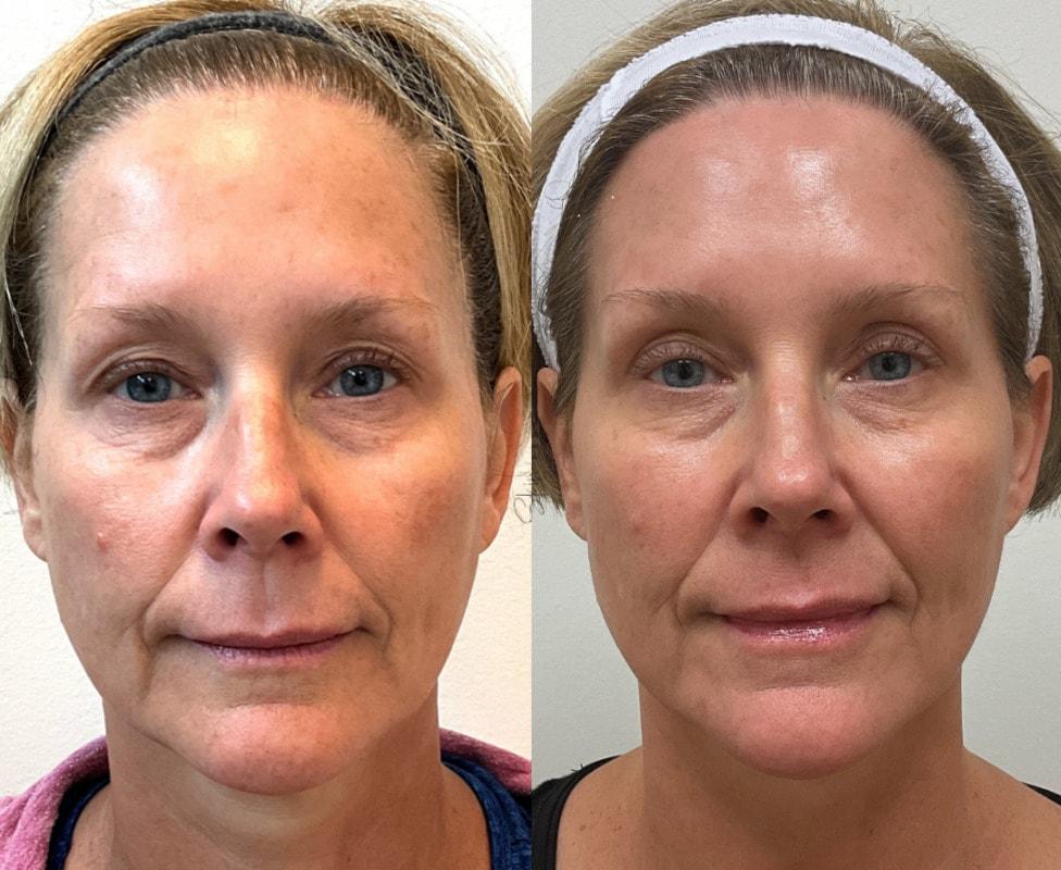 SkinPerfected microneedling result — Woodridge, IL