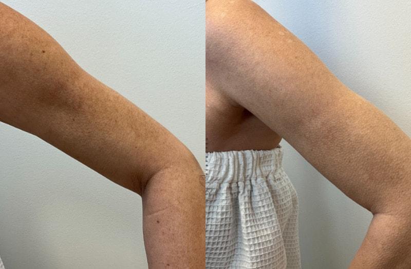 SkinPerfected photofacial result — Woodridge, IL