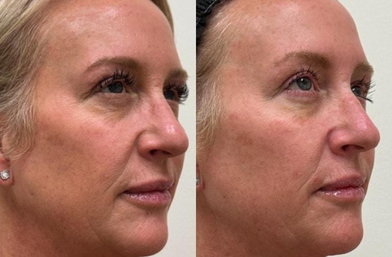 SkinPerfected microneedling result — Woodridge, IL